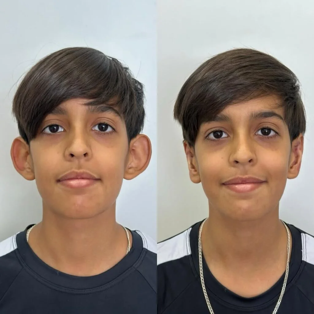 Antes e depois de otomodelação