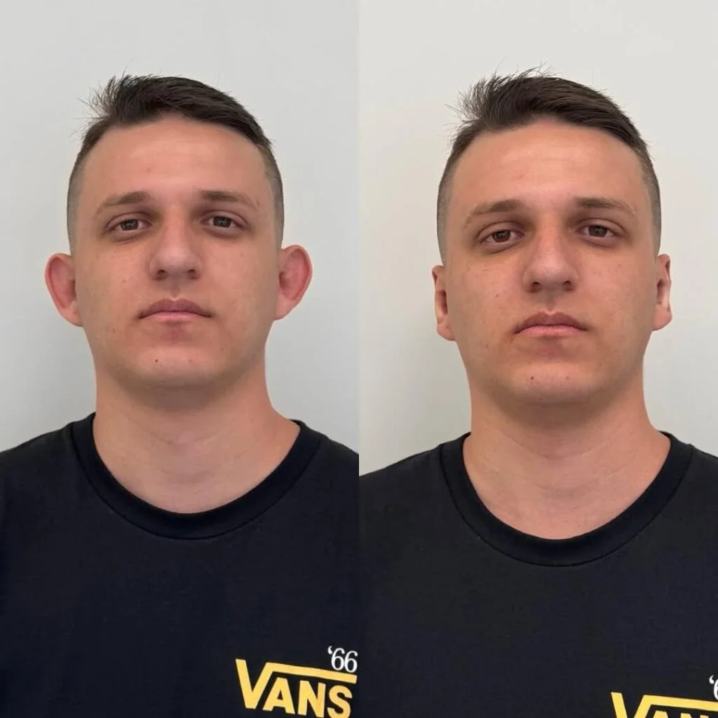 Antes e depois de otomodelação