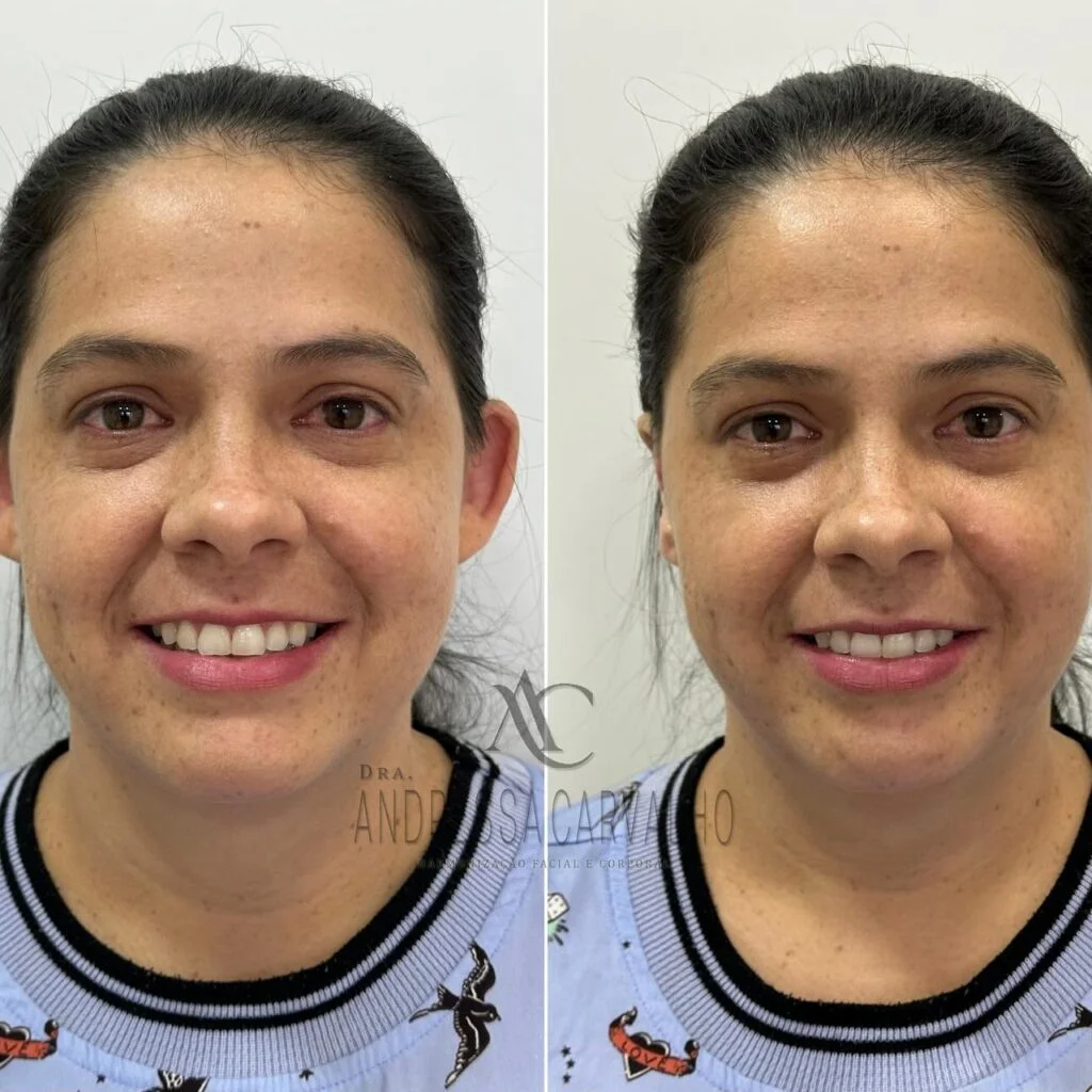 Antes e depois